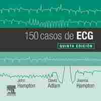 150 CASOS DE ECG