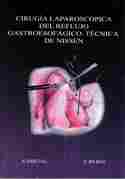 CIRUGIA LAPAROSCOPICA DEL REFLUJO GASTROESOFAGICO TECNICA DE NISSEN